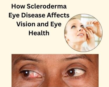 How Scleroderma Eye Disease Affects Vision And Eye Health