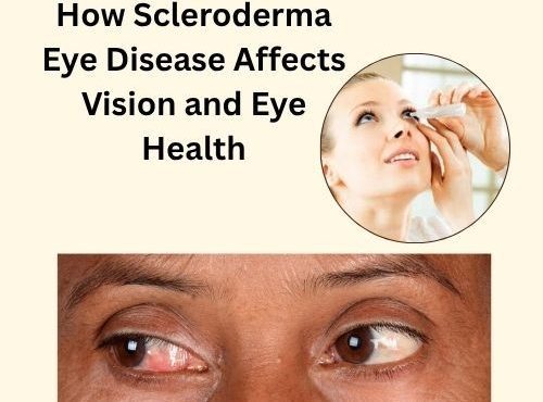 How Scleroderma Eye Disease Affects Vision And Eye Health