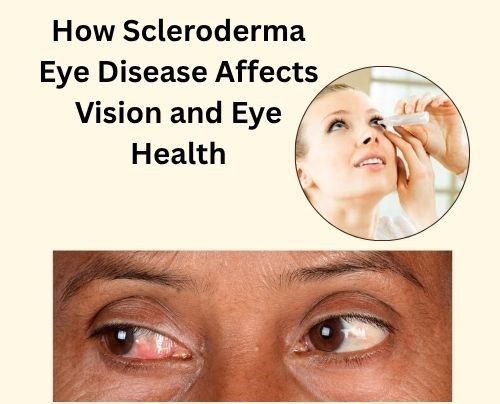 How Scleroderma Eye Disease Affects Vision And Eye Health