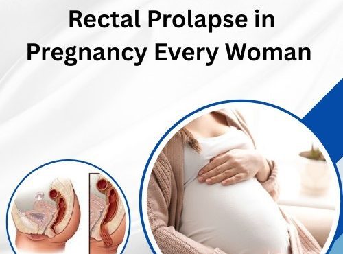 Rectal Prolapse in Pregnancy