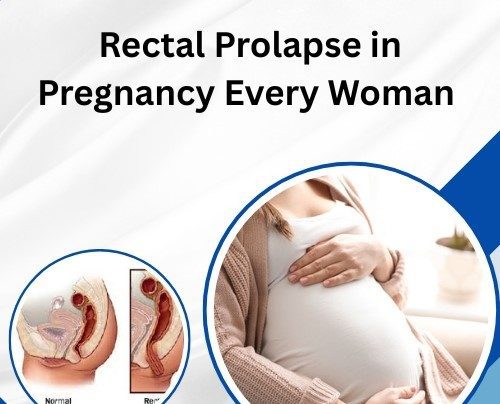 Rectal Prolapse in Pregnancy