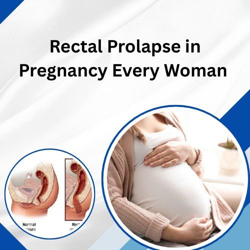 Critical Signs of Rectal Prolapse in Pregnancy Every Woman Should Know