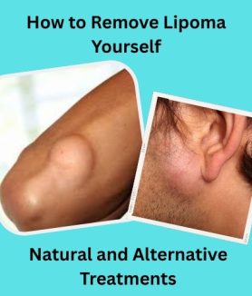How to Remove Lipoma Yourself