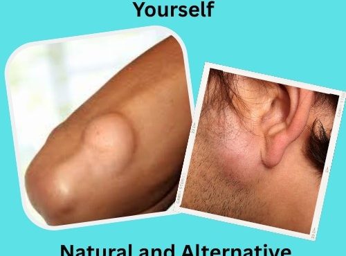 How to Remove Lipoma Yourself