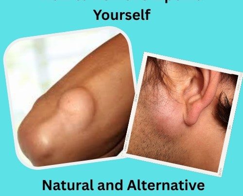 How to Remove Lipoma Yourself