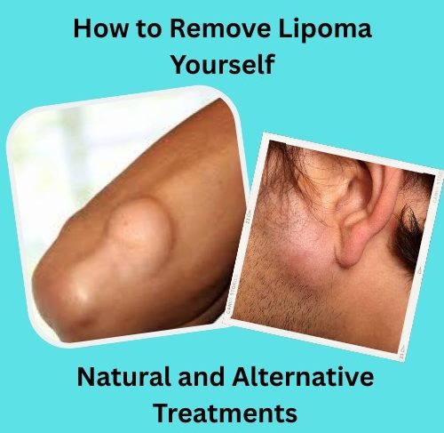 How to Remove Lipoma Yourself