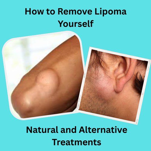 How to Remove Lipoma Yourself: Natural and Alternative Treatments
