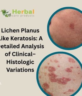 Lichen Planus Like Keratosis