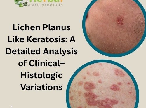 Lichen Planus Like Keratosis