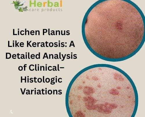 Lichen Planus Like Keratosis