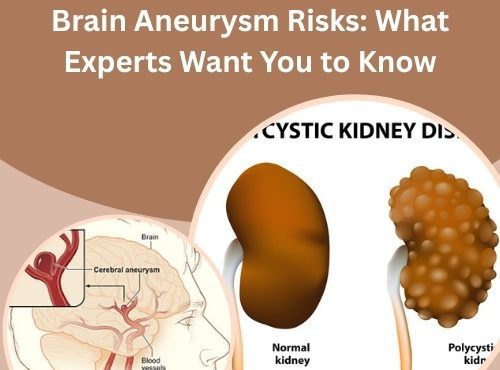 Polycystic Kidney Disease and Brain Aneurysm Risks