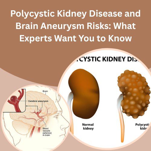 Polycystic Kidney Disease and Brain Aneurysm Risks: What Experts Want You to Know