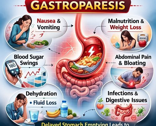 Complications of Gastroparesis