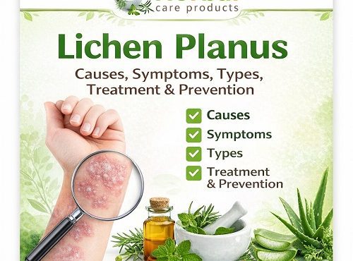 Overview of Lichen Planus