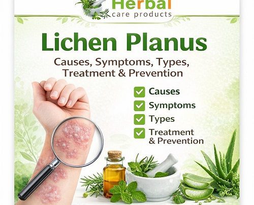 Overview of Lichen Planus
