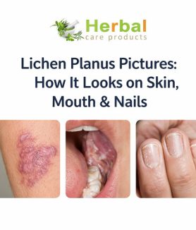 Lichen Planus pictures