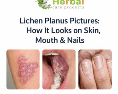 Lichen Planus pictures