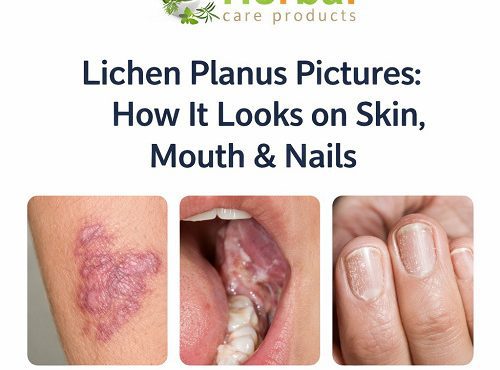 Lichen Planus pictures