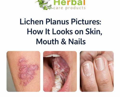 Lichen Planus pictures
