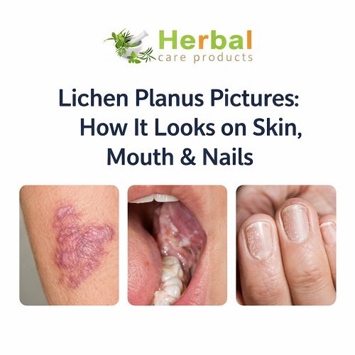 Lichen Planus Pictures: How It Looks on Skin, Mouth & Nails