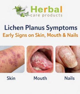 Lichen Planus Symptoms