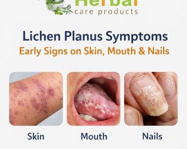 Lichen Planus Symptoms