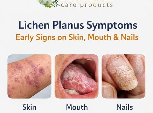 Lichen Planus Symptoms