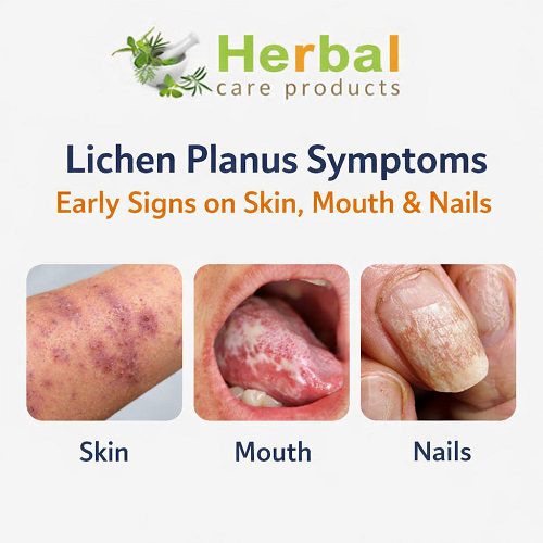 Lichen Planus Symptoms: Early Signs on Skin, Mouth & Nails