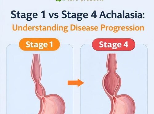 stages of achalasia