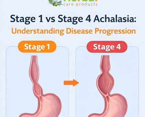 stages of achalasia