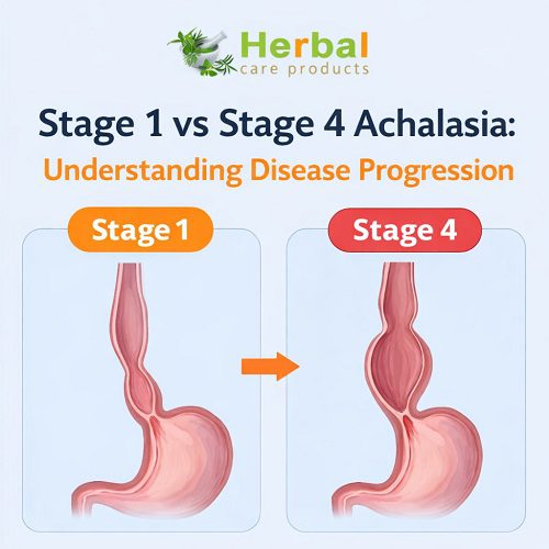 Stage 1 vs Stage 4 Achalasia: Understanding Disease Progression