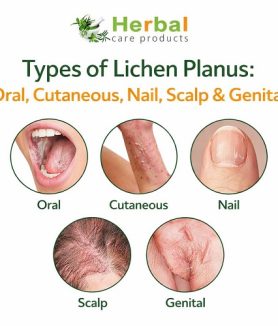 Types of Lichen Planus