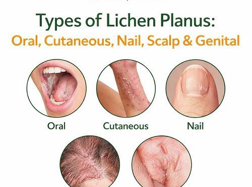 Types of Lichen Planus