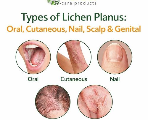 Types of Lichen Planus