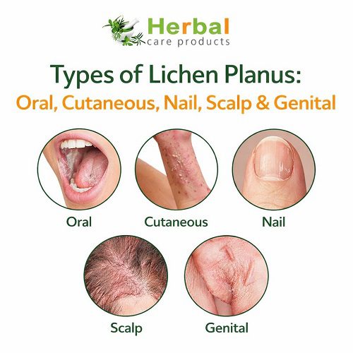 Types of Lichen Planus: Oral, Cutaneous, Nail, Scalp & Genital