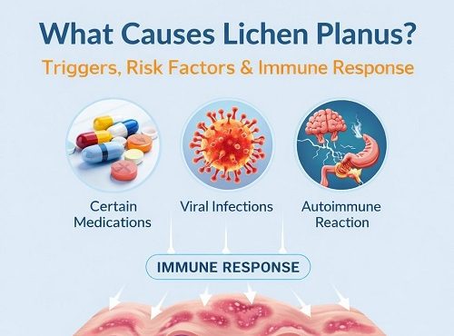 Lichen Planus Causes