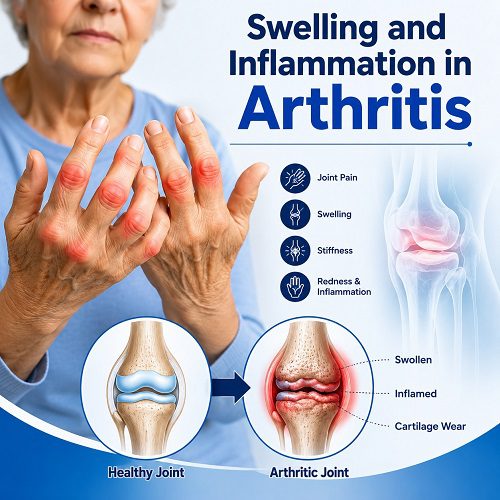 Swelling and Inflammation in Arthritis