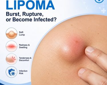 Can a Lipoma Burst