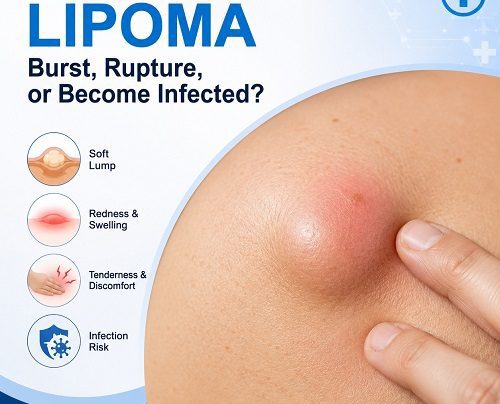 Can a Lipoma Burst