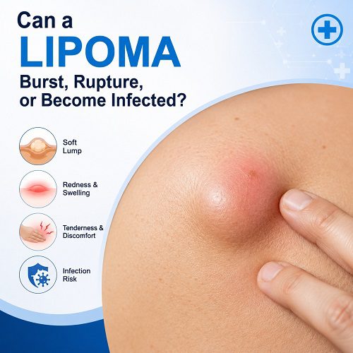 Can a Lipoma Burst, Rupture or Become Infected?