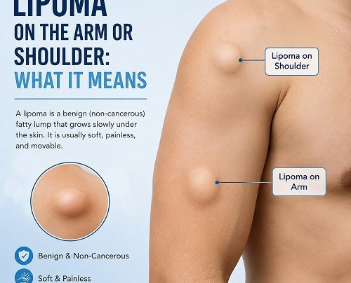Lipoma on Arm