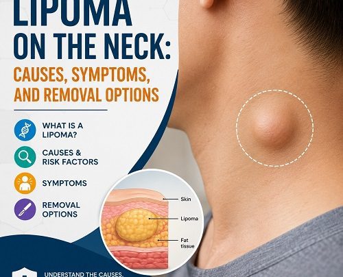 Lipoma on the Neck