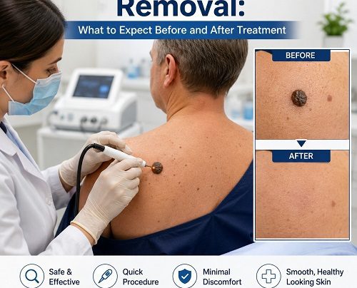 Dermatologist performing seborrheic keratosis removal on a patient's shoulder during a skin treatment consultation.