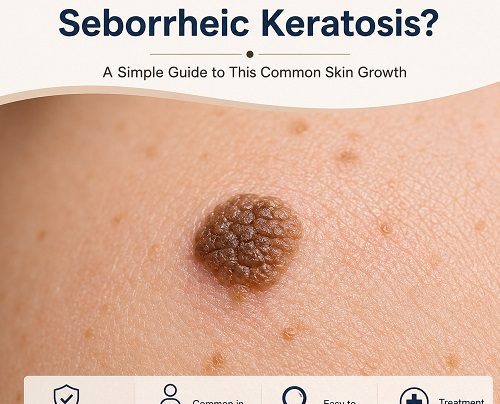 What Is Seborrheic Keratosis