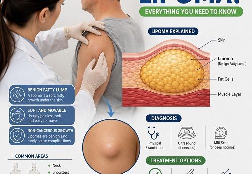 A healthcare professional examining a benign fatty lump (lipoma) on an adult patient's shoulder while explaining lipoma symptoms and treatment options.