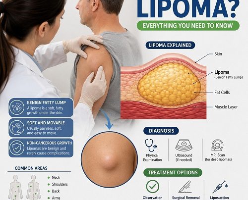 A healthcare professional examining a benign fatty lump (lipoma) on an adult patient's shoulder while explaining lipoma symptoms and treatment options.