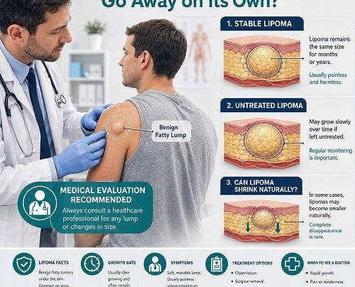 Doctor examining a soft lipoma while explaining whether lipomas can go away or shrink naturally without treatment.