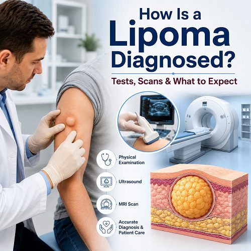 How Is a Lipoma Diagnosed? Tests, Scans, and What to Expect
