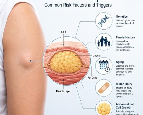 What causes lipoma illustration showing common lipoma risk factors and fatty lump beneath the skin