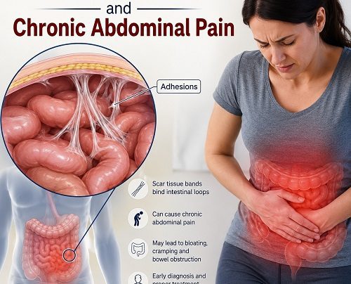 Medical illustration showing abdominal adhesions causing chronic abdominal pain by restricting and pulling on intestinal organs.